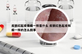 皮肤红起皮像癣一样是什么 皮肤红色起皮和癣一样的怎么回事