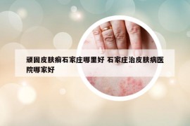 顽固皮肤癣石家庄哪里好 石家庄治皮肤病医院哪家好