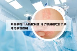 银屑病吃什么能控制住 得了银屑病吃什么药才把病情控制