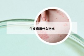 牛皮癣用什么泡水