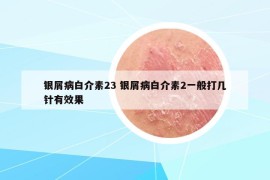 银屑病白介素23 银屑病白介素2一般打几针有效果