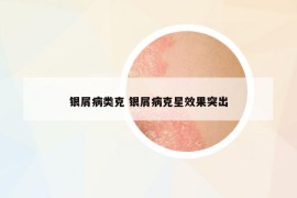 银屑病类克 银屑病克星效果突出