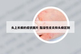 头上长癣的症状图片 脂溢性皮炎和头癣区别