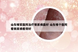 山东哪家医院治疗银屑病最好 山东哪个医院看银屑病看得好