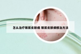 怎么治疗银屑皮肤病 银屑皮肤病根治方法