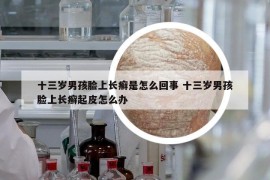 十三岁男孩脸上长癣是怎么回事 十三岁男孩脸上长癣起皮怎么办