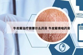 牛皮廨治疗需要什么药膏 牛皮廨用啥药膏