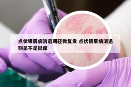 点状银屑病消退期轻微复发 点状银屑病消退期是不是很痒