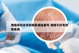 情绪波动会导致银屑病加重吗 情绪不好导致银屑病