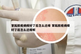 掌跖脓疱病痒好了后怎么还痒 掌跖脓疱病痒好了后怎么还痒呢