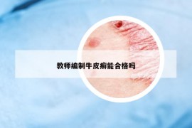 教师编制牛皮癣能合格吗