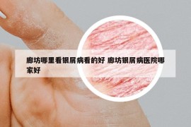 廊坊哪里看银屑病看的好 廊坊银屑病医院哪家好