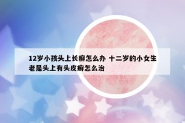 12岁小孩头上长癣怎么办 十二岁的小女生老是头上有头皮癣怎么治