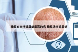 绿豆方治疗银屑病是真的吗 绿豆汤治银屑病