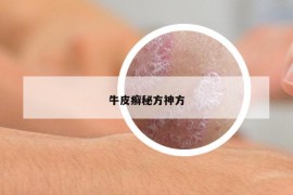 牛皮癣秘方神方