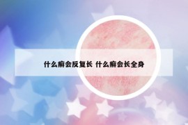 什么癣会反复长 什么癣会长全身