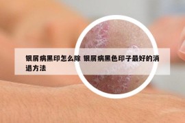 银屑病黑印怎么除 银屑病黑色印子最好的消退方法