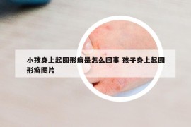 小孩身上起圆形癣是怎么回事 孩子身上起圆形癣图片