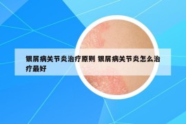 银屑病关节炎治疗原则 银屑病关节炎怎么治疗最好