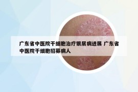 广东省中医院干细胞治疗银屑病进展 广东省中医院干细胞招募病人