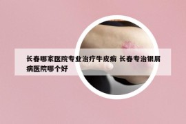 长春哪家医院专业治疗牛皮癣 长春专治银屑病医院哪个好