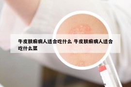 牛皮肤癣病人适合吃什么 牛皮肤癣病人适合吃什么菜