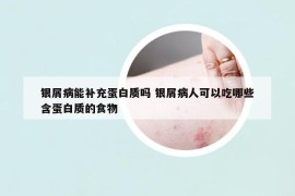 银屑病能补充蛋白质吗 银屑病人可以吃哪些含蛋白质的食物