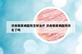 济南银屑病医院怎样治疗 济南银屑病医院改名了吗