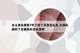 女儿有头癣有7年了好了又发怎么办 小孩头癣好了会重新长出头发吗