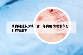 生物制剂多少钱一针一年费用 生物制剂打一针有效果不