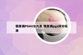 银屑病PGA6分代表 银屑病pga评分标准