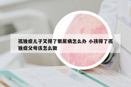 孤独症儿子又得了银屑病怎么办 小孩得了孤独症父母该怎么做