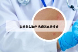 头癣怎么治疗 头癣怎么治疗好