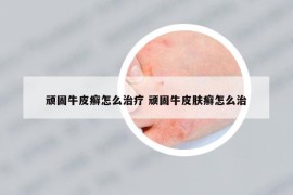 顽固牛皮癣怎么治疗 顽固牛皮肤癣怎么治