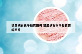 银屑病有孢子和真菌吗 银屑病有孢子和真菌吗图片