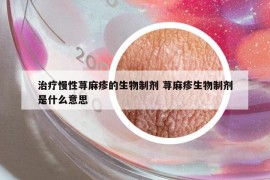 治疗慢性荨麻疹的生物制剂 荨麻疹生物制剂是什么意思