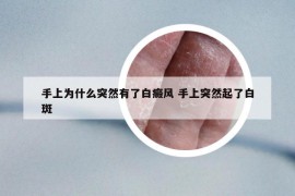 手上为什么突然有了白癜风 手上突然起了白斑