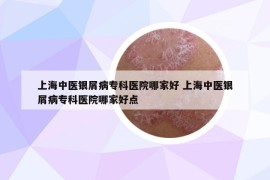 上海中医银屑病专科医院哪家好 上海中医银屑病专科医院哪家好点