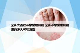 全身大面积寻常型银屑病 全身寻常型银屑病用药多久可以消退