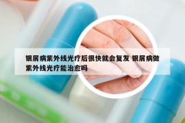 银屑病紫外线光疗后很快就会复发 银屑病做紫外线光疗能治愈吗