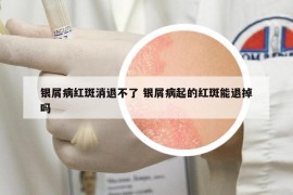 银屑病红斑消退不了 银屑病起的红斑能退掉吗