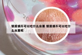 银屑病不可以吃什么水果 银屑病不可以吃什么水果呢