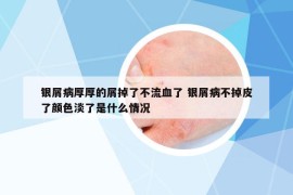 银屑病厚厚的屑掉了不流血了 银屑病不掉皮了颜色淡了是什么情况