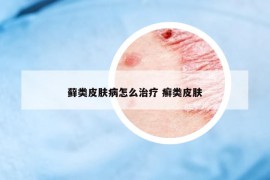 藓类皮肤病怎么治疗 癣类皮肤