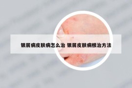 银屑病皮肤病怎么治 银屑皮肤病根治方法