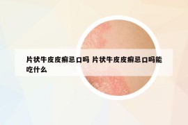 片状牛皮皮癣忌口吗 片状牛皮皮癣忌口吗能吃什么