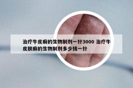 治疗牛皮癣的生物制剂一针3000 治疗牛皮肤癣的生物制剂多少钱一针