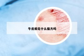 牛皮癣走什么偏方吗