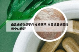 南昌市疗效好的牛皮癣医院 南昌银屑病医院哪个口碑好