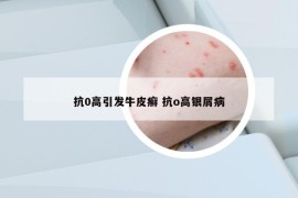 抗0高引发牛皮癣 抗o高银屑病